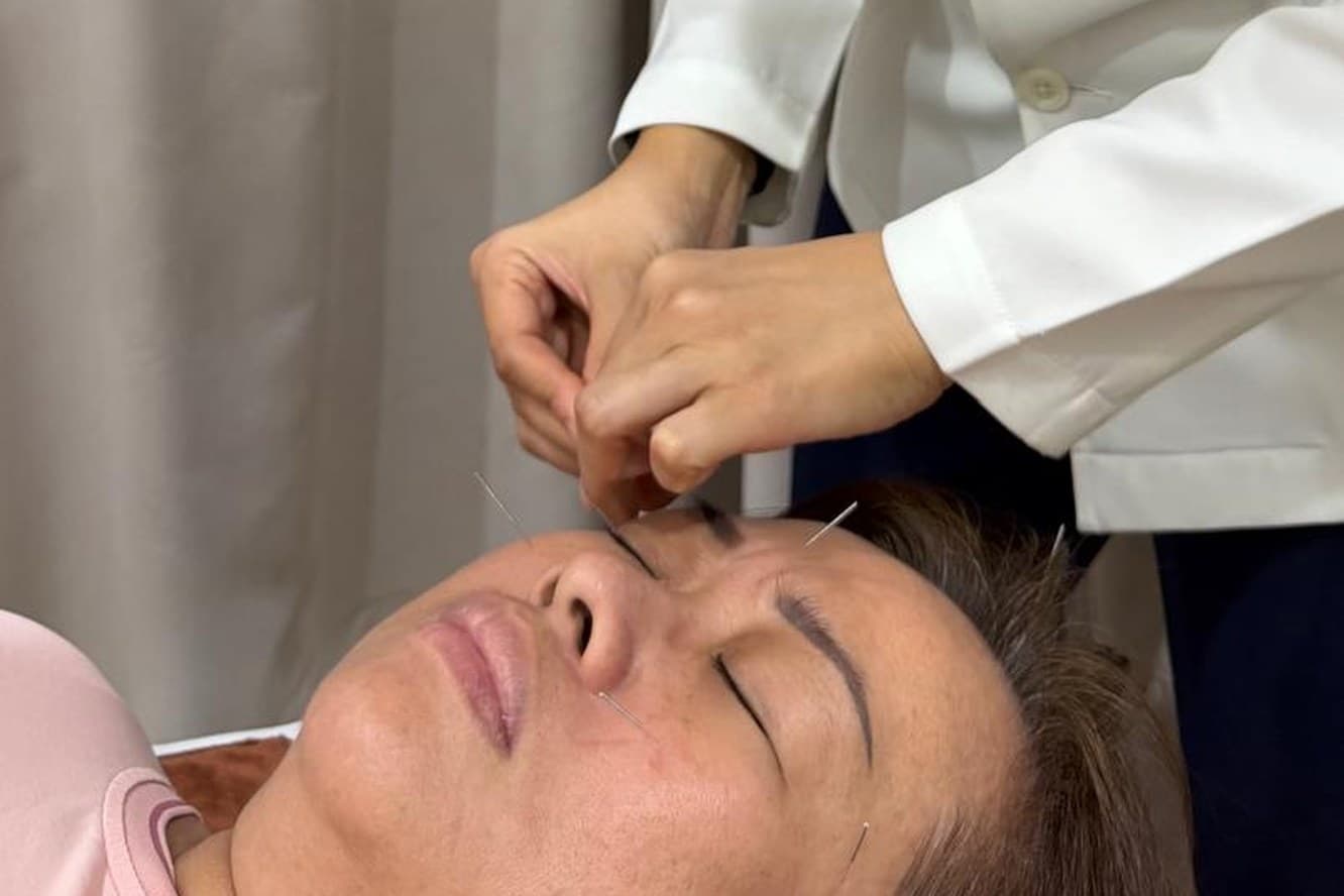 A physician placing a fine needle at a point on a patient's brow, with several needles already in place across the forehead and cheek. The patient is lying down with eyes closed.