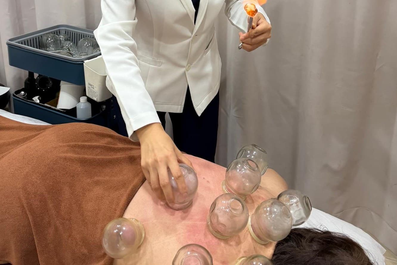 A physician pressing a glass cup onto a patient's back while holding a lit flame in the other hand, with several cups already in place.